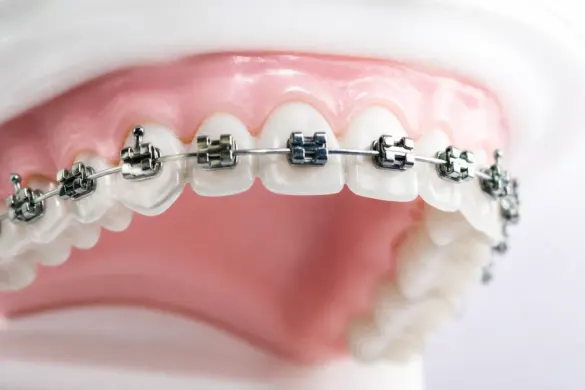 Vreau aparat dentar metalic