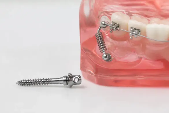 Mini-implant ortodontic pentru ancoraj temporar
